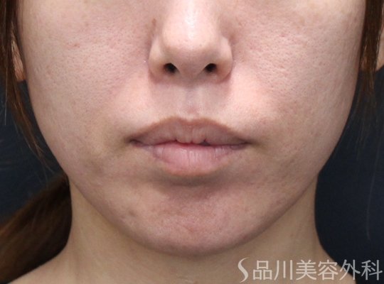 症例NO.75361のBEFORE写真