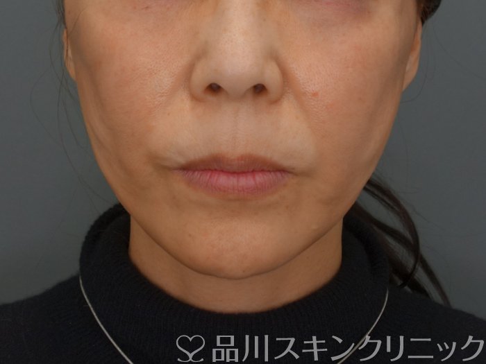症例NO.74804のAFTER写真