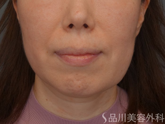症例NO.74667のBEFORE写真