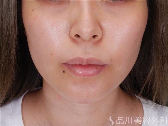 症例NO.59549のBEFORE写真