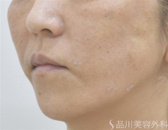 症例NO.46599のAFTER写真