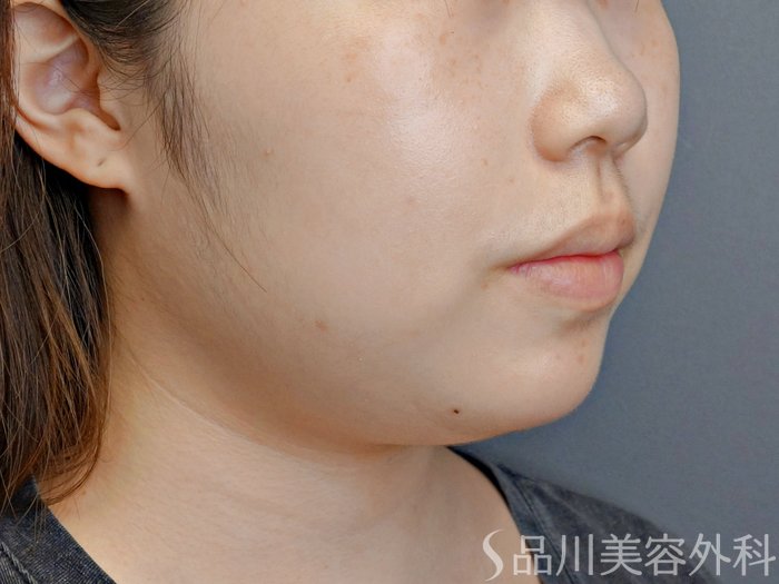 症例NO.73387のBEFORE写真