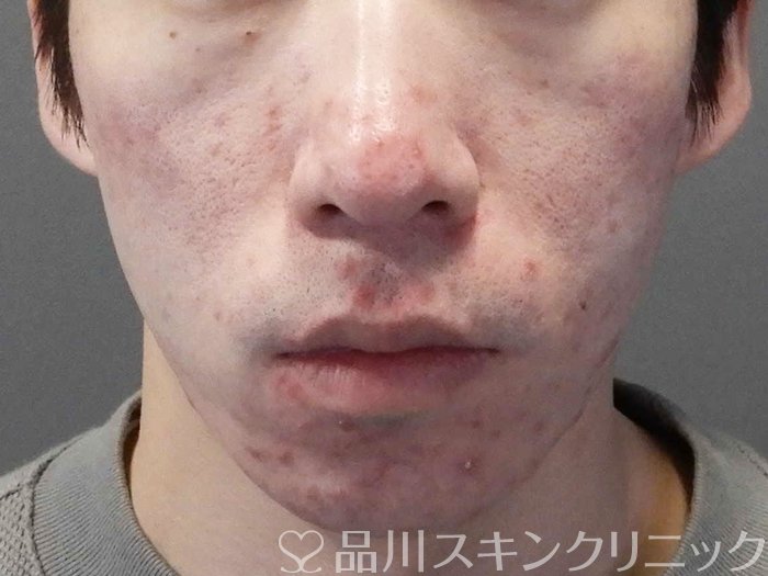 症例NO.69377のBEFORE写真