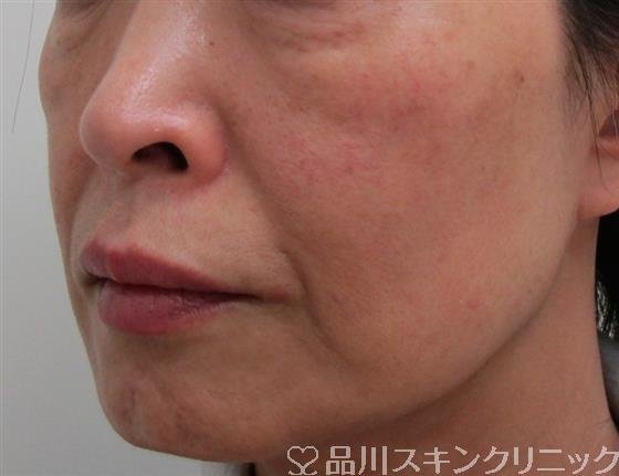 症例NO.33713のBEFORE写真