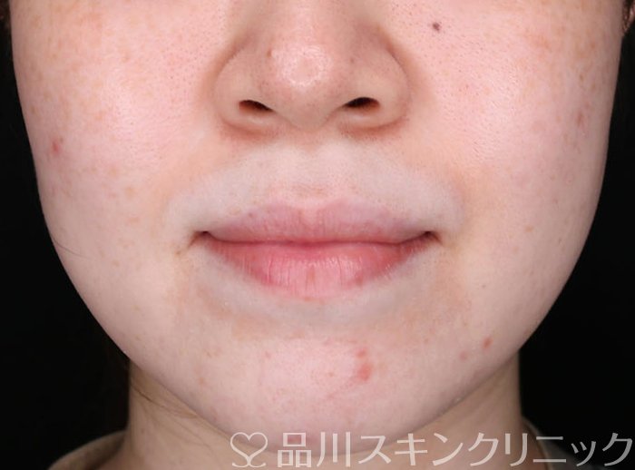 症例NO.65816のBEFORE写真