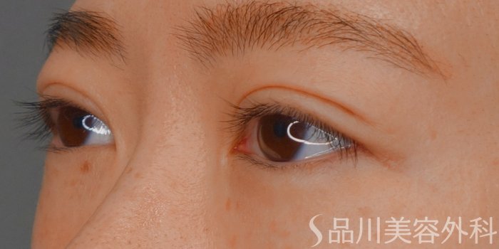 症例NO.73527のAFTER写真