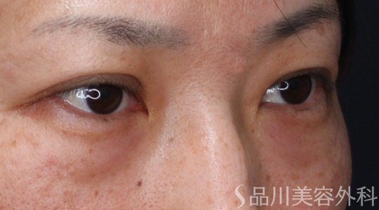 症例NO.64571のAFTER写真
