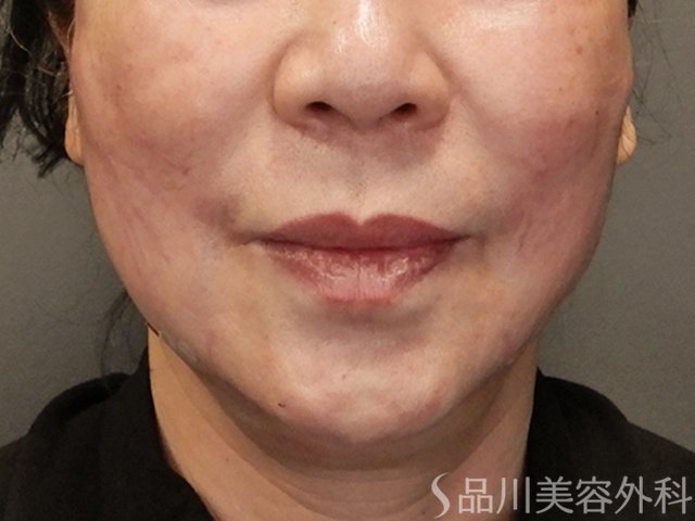 症例NO.73651のAFTER写真