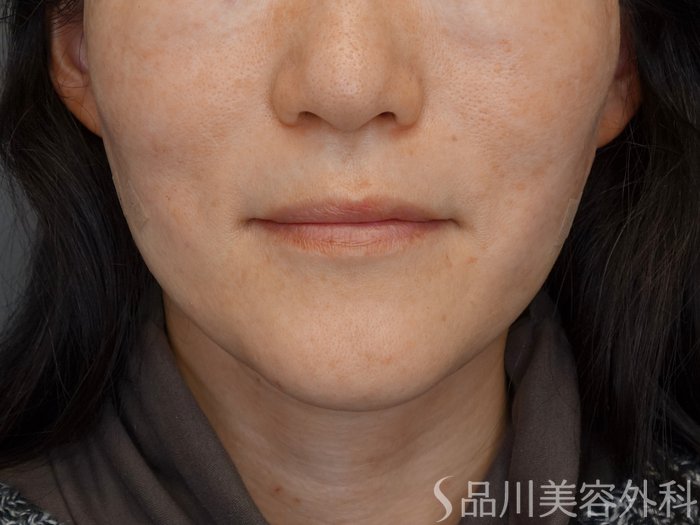 症例NO.72865のAFTER写真