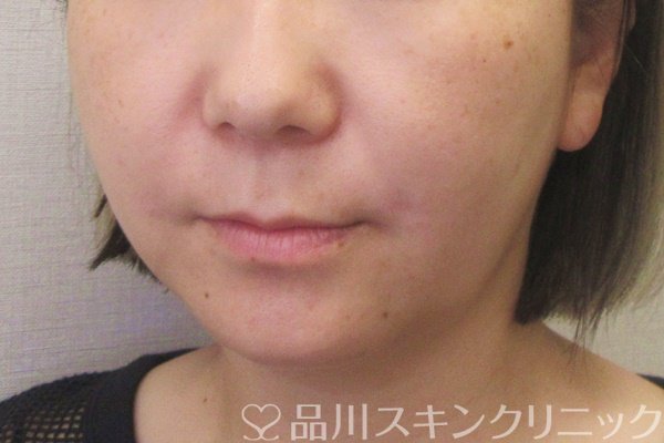 症例NO.70410のAFTER写真