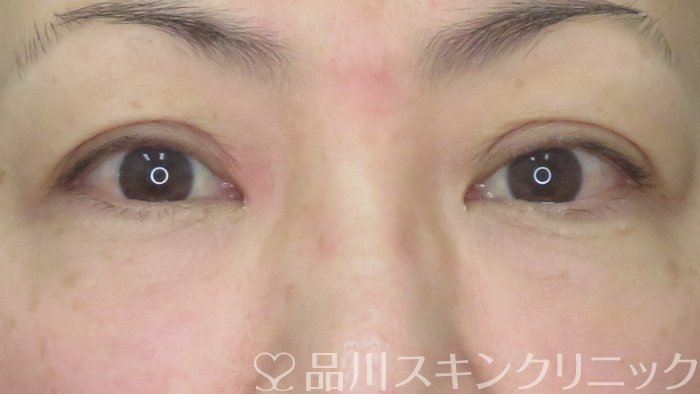 症例NO.72675のAFTER写真