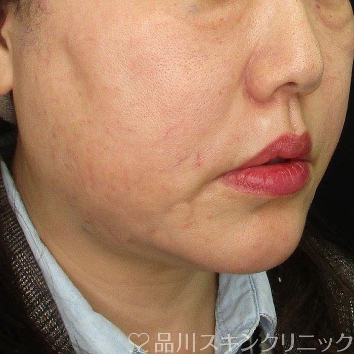 症例NO.73912のAFTER写真
