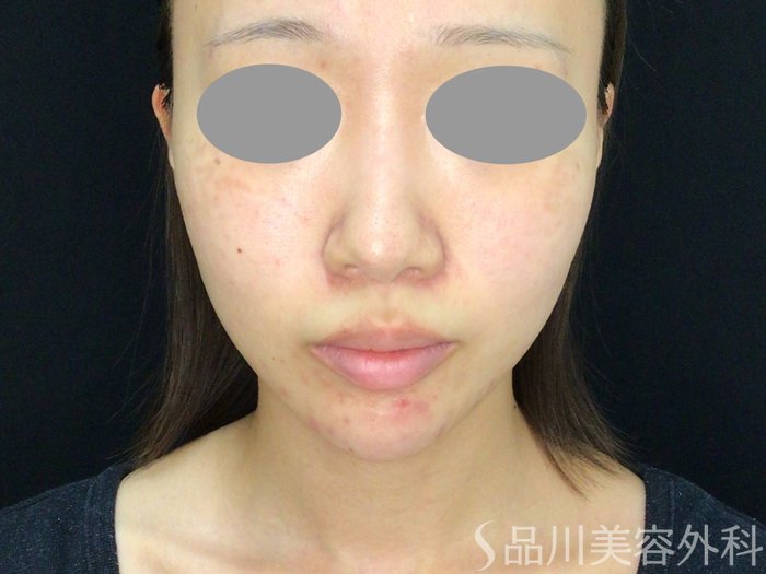 症例NO.71827のBEFORE写真