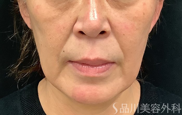 症例NO.67887のBEFORE写真