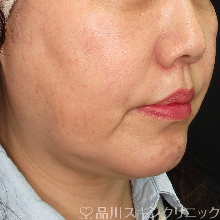 症例NO.73912のBEFORE写真