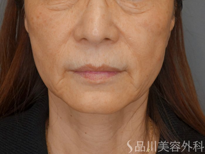 症例NO.75095のBEFORE写真