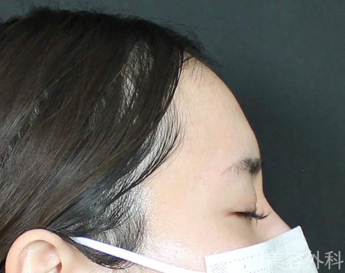 症例NO.70297のBEFORE写真