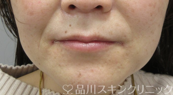 症例NO.74110のBEFORE写真