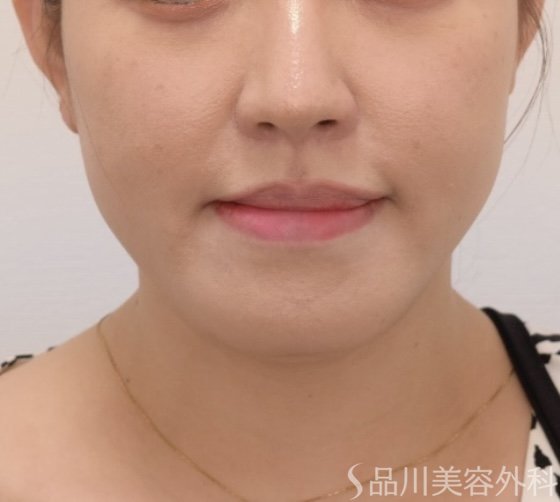 症例NO.71659のAFTER写真