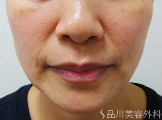 症例NO.73051のBEFORE写真