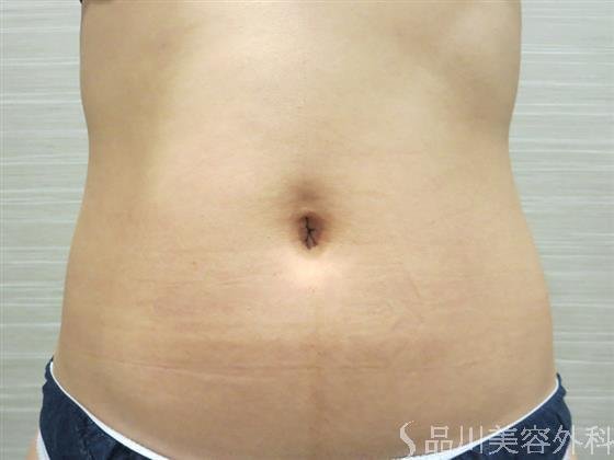 症例NO.23308のBEFORE写真