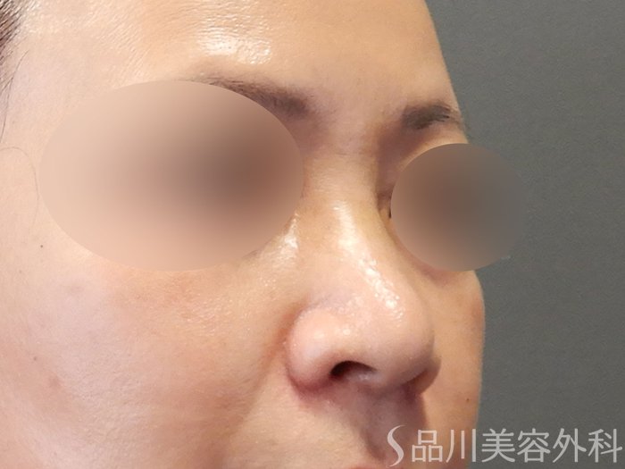 症例NO.70618のAFTER写真