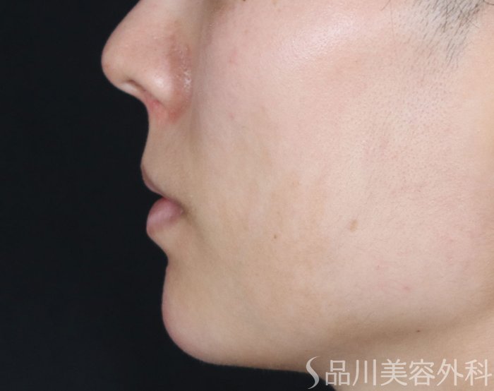 症例NO.72347のAFTER写真