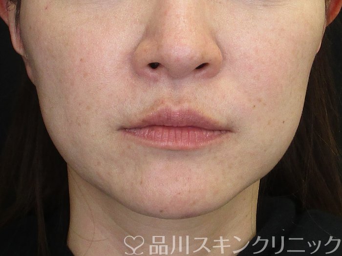 症例NO.72630のBEFORE写真