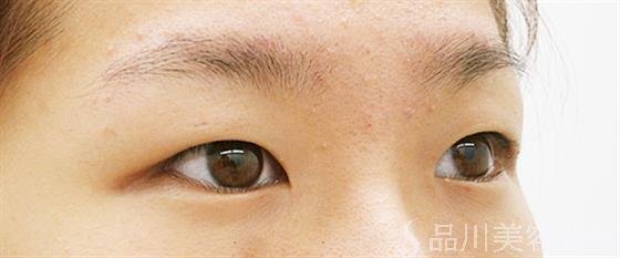 症例NO.25020のBEFORE写真