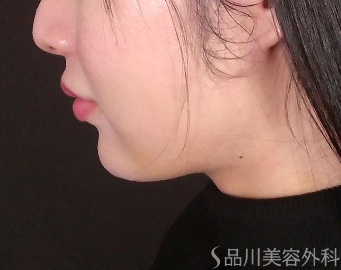 症例NO.69590のAFTER写真
