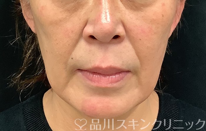 症例NO.67887のBEFORE写真