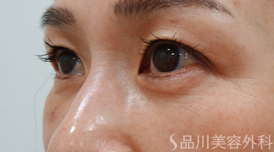 症例NO.70888のAFTER写真
