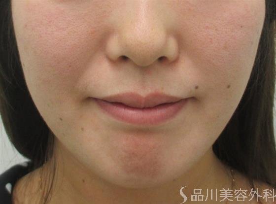 症例NO.20223のBEFORE写真