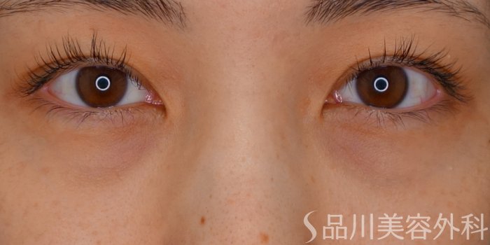 症例NO.70149のBEFORE写真