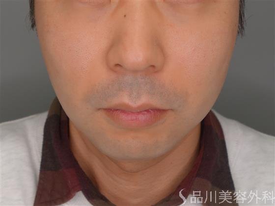 症例NO.53677のBEFORE写真