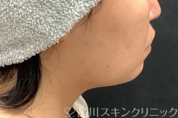 症例NO.69513のBEFORE写真