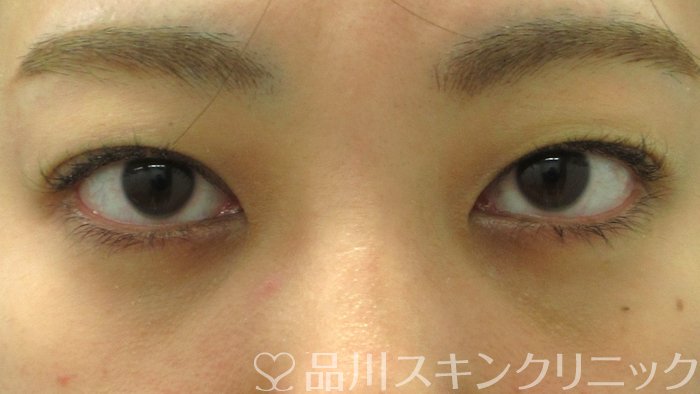 症例NO.70508のAFTER写真