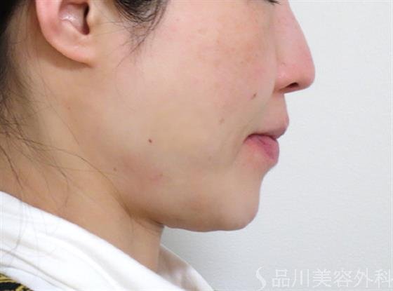 症例NO.27463のBEFORE写真