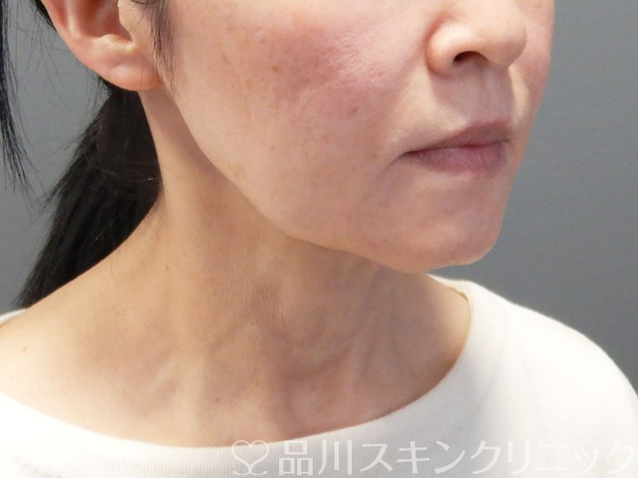 症例NO.74942のBEFORE写真