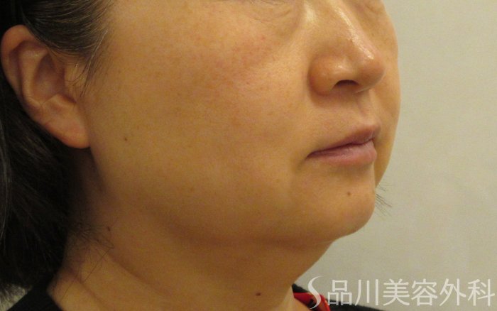 症例NO.71426のBEFORE写真