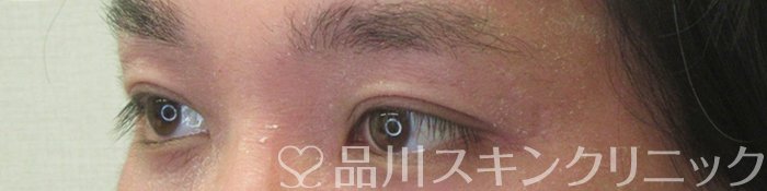 症例NO.74413のAFTER写真