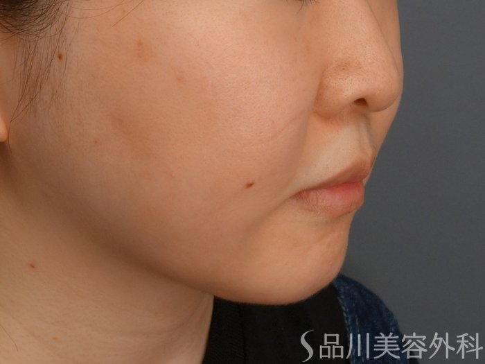 症例NO.73754のAFTER写真