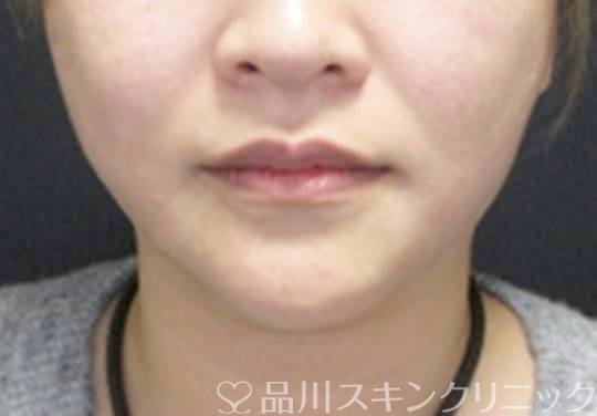 症例NO.72962のAFTER写真