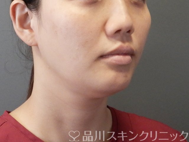 症例NO.65894のBEFORE写真