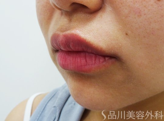 症例NO.72326のAFTER写真