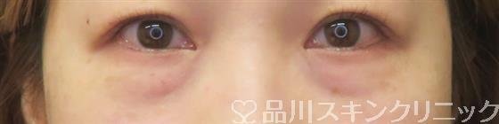 症例NO.59909のBEFORE写真
