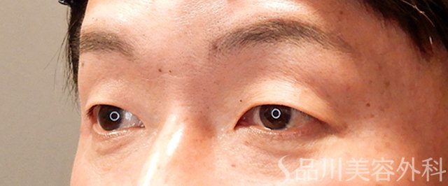 症例NO.69298のBEFORE写真