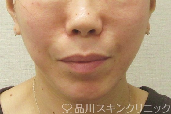 症例NO.75110のAFTER写真