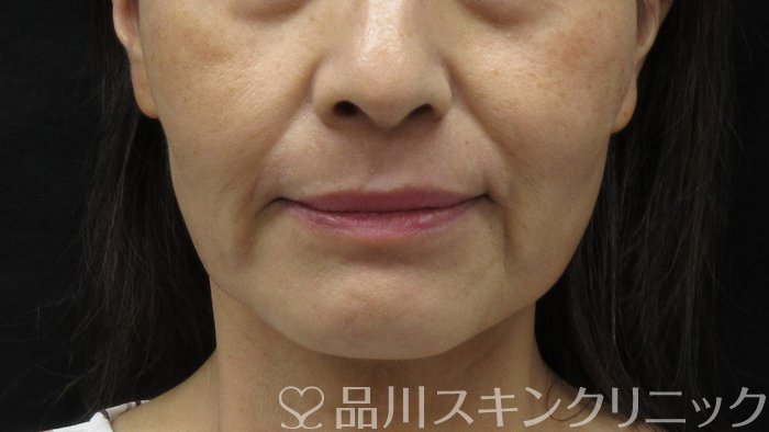 症例NO.71434のAFTER写真