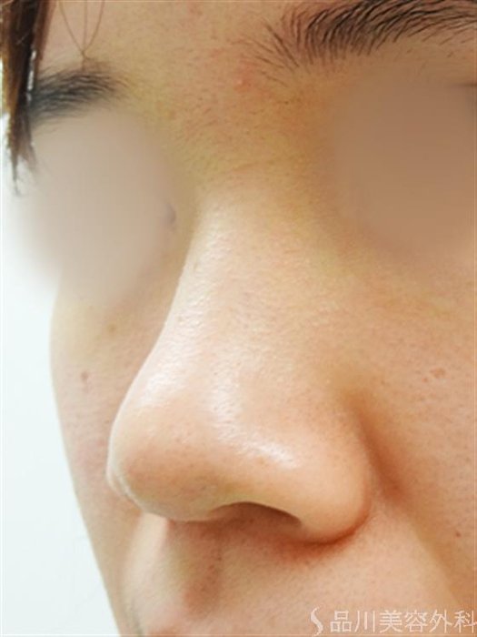 症例NO.30854のBEFORE写真